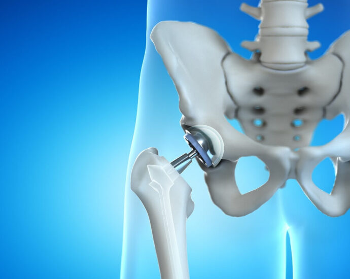 Anterior Hip Replacement