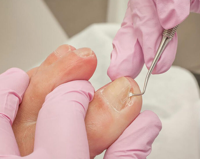 Ingrown Toenails