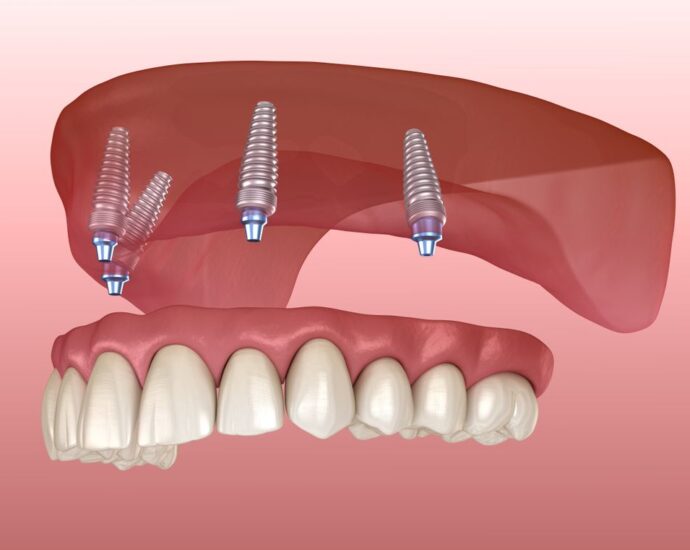 Multiple Implants Aberdeen