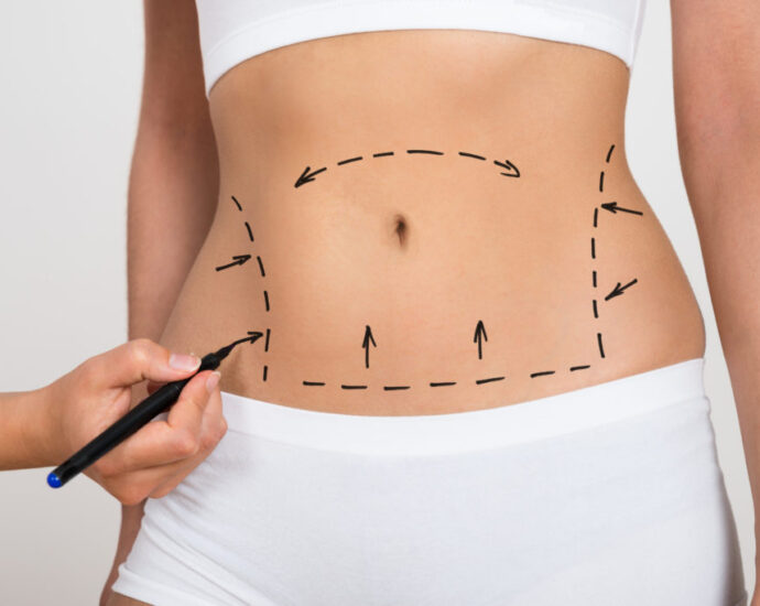 Liposuction Surgery in Dubai