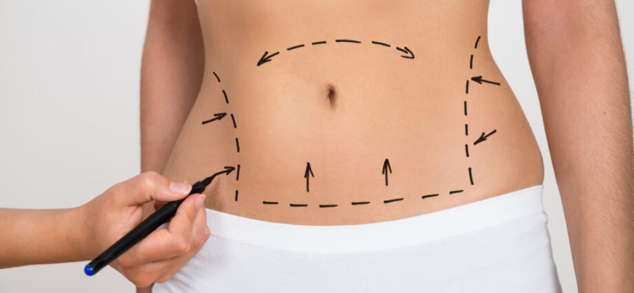 Liposuction Surgery in Dubai